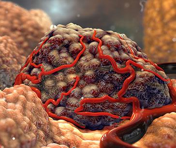 Visual depiction of Tumor Ablation Visual depiction of Tumor Ablation